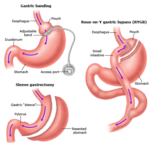 gastric surgery